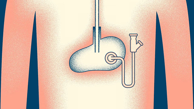 An illustration of a feeding tube in a grainy 70s biology textbook style.